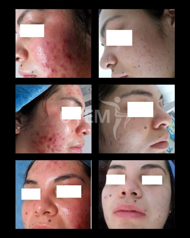 ACNE-CN-MARCA-AGUA-CUADRADA