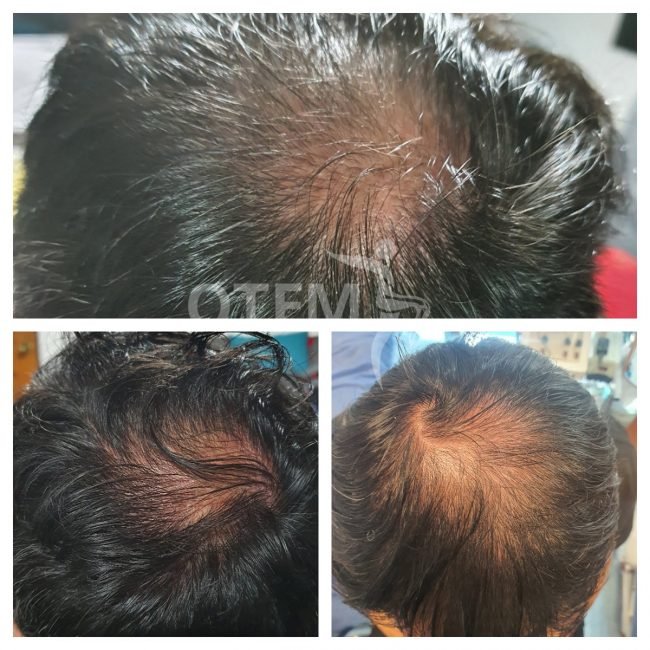 ALOPECIA-CN-MARCA-AGUA-CUADRADA