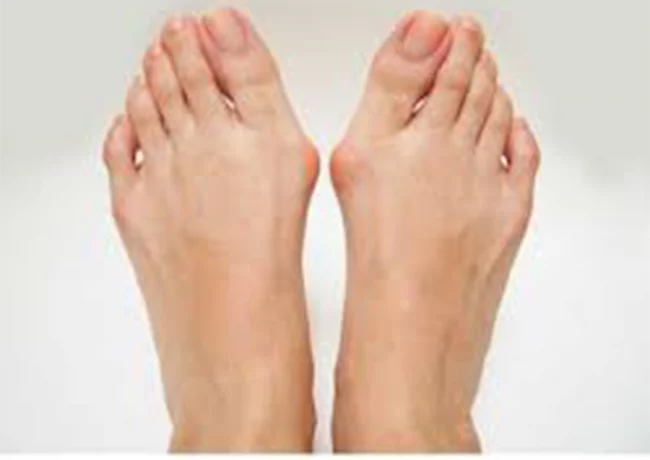 Hallux Valgus