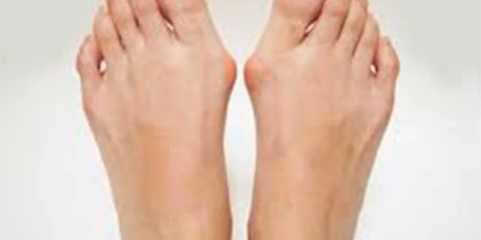 Hallux Valgus