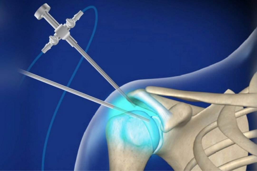 Artroscopia de hombro