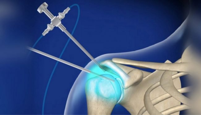 artroscopia Artroscopia de hombro