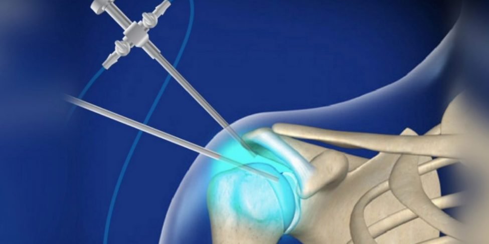 artroscopia Artroscopia de hombro