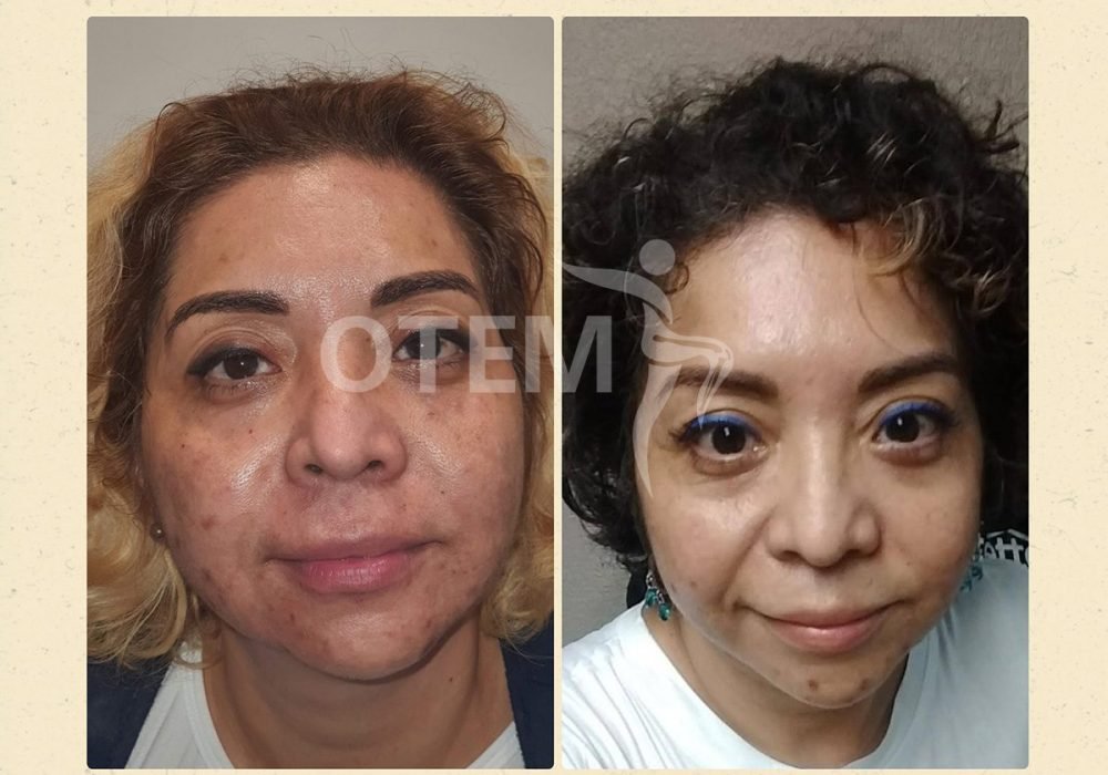 Eliminación de manchas